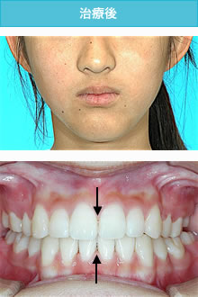 偏位咬合の治療後