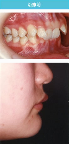 過蓋咬合の治療前