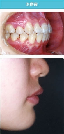 過蓋咬合の治療後
