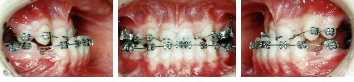 矯正装置装着時