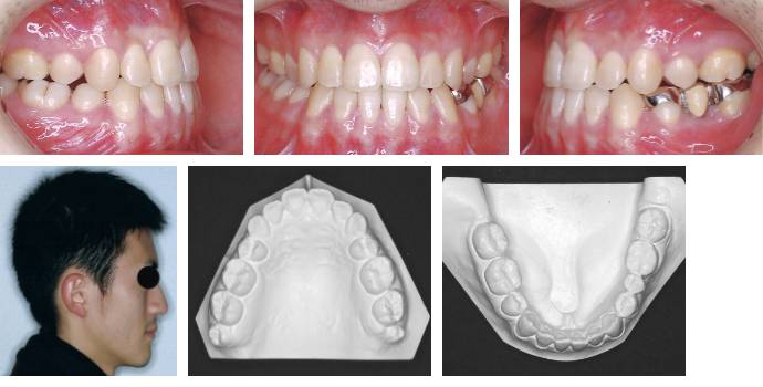 矯正治療終了後