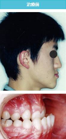 下突咬合の治療前