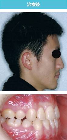 下突咬合の治療後