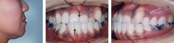 受け口の治療前 口元と歯並び