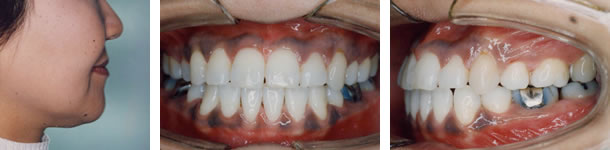 受け口の治療後 口元と歯並び