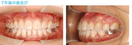 受け口の治療 ７年後の歯並び