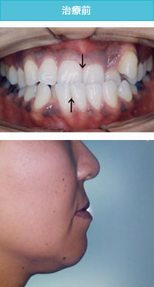 受け口の治療前