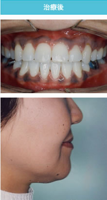 受け口の治療後