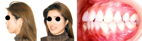 両突歯列の治療前 口元と歯並び