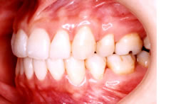 両突歯列の治療後 歯並び