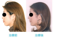 両突歯列の治療後 横顔と口元