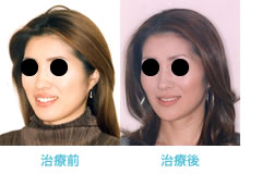 両突歯列の治療後 口元のバランス