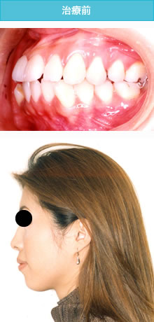 両突歯列の治療前