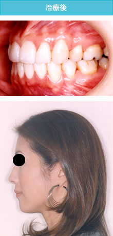 両突歯列の治療後