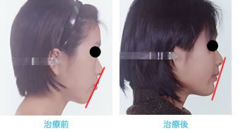 叢生と両突歯列のEラインの変化