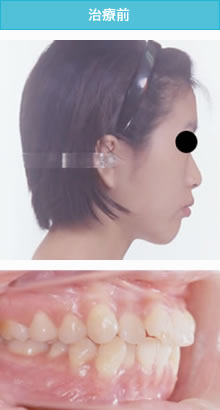 叢生と両突歯列の治療前