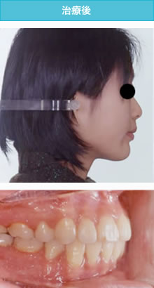 叢生と両突歯列の治療後