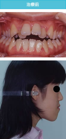 開咬合の治療前