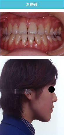 開咬合の治療後