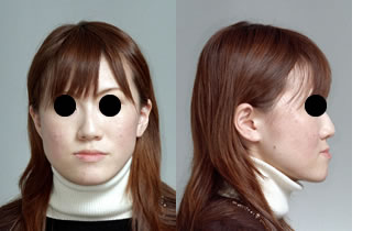 偏位咬合の顎ラインと口元