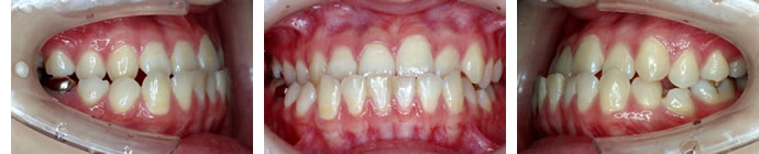 偏位咬合の治療前　歯並び