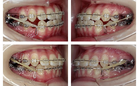 偏位咬合の治療中　歯並び