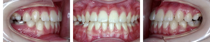 偏位咬合の治療後　歯並び