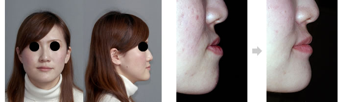 偏位咬合の治療後　顎のラインと口元