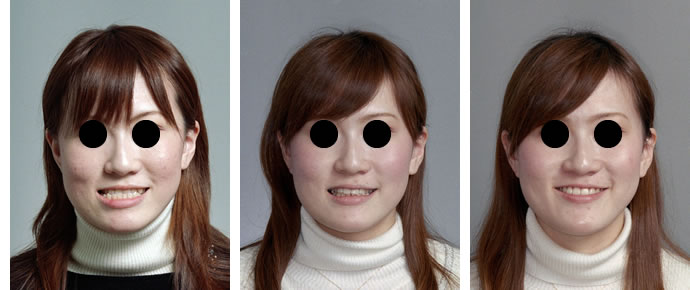 偏位咬合の治療後のスマイルトレーニング