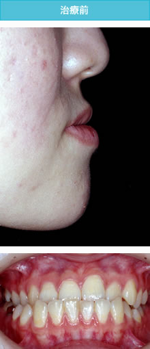 偏位咬合の治療前