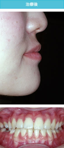 偏位咬合の治療後