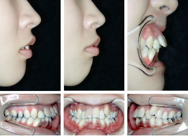 出っ歯の治療前 口元と歯並び