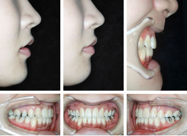 出っ歯の治療後 口元と歯並び