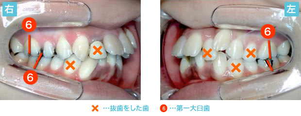 出っ歯の治療で抜歯した歯