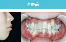出っ歯の治療前