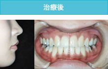 出っ歯の治療後