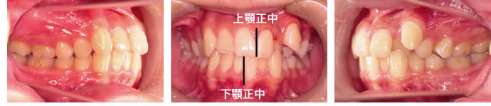 偏位咬合の治療前　歯並び