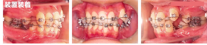 偏位咬合の装置装着後 歯並び