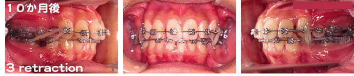 偏位咬合の治療10か月後 歯並び