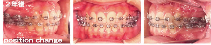偏位咬合の治療の２年後 歯並び
