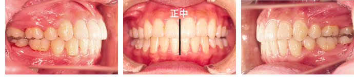 偏位咬合の治療後 歯並び