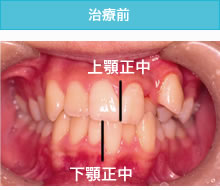 偏位咬合の治療前
