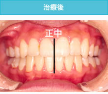 偏位咬合の治療後