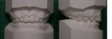 出っ歯の治療終了時の歯型模型