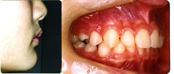 治療後の口元と口腔内
