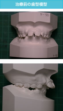 出っ歯の治療前の歯型模型