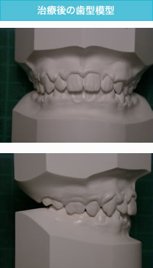 出っ歯の治療後の歯型模型