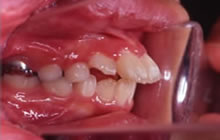 出っ歯の治療開始前