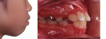 出っ歯の１期治療終了時