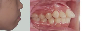 出っ歯の２期治療開始時